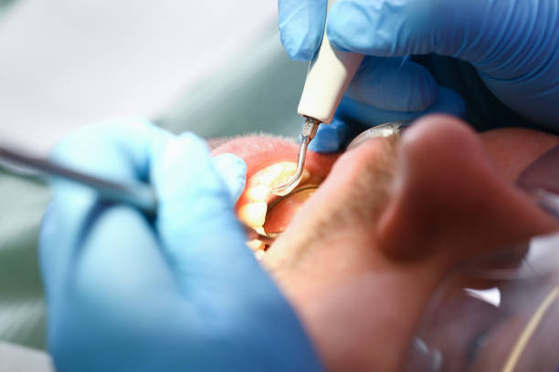 Best Emergency Wisdom Teeth Removal in Collinsville, TX